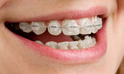 Un)Traditional Braces, Colored Metal Braces in Milwaukee WI, Beloit WI,  and Roscoe IL